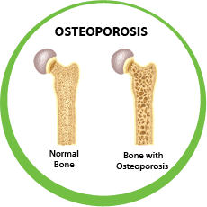 Osteoporosis, bones & teeth